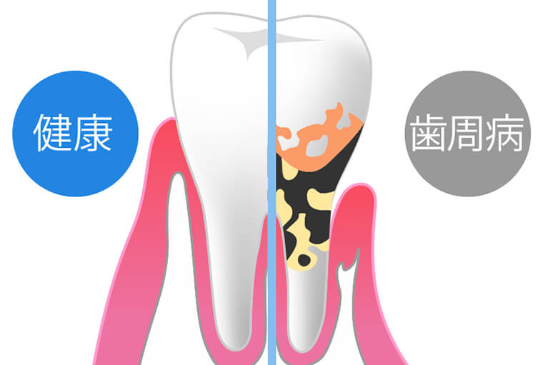 歯周病予防